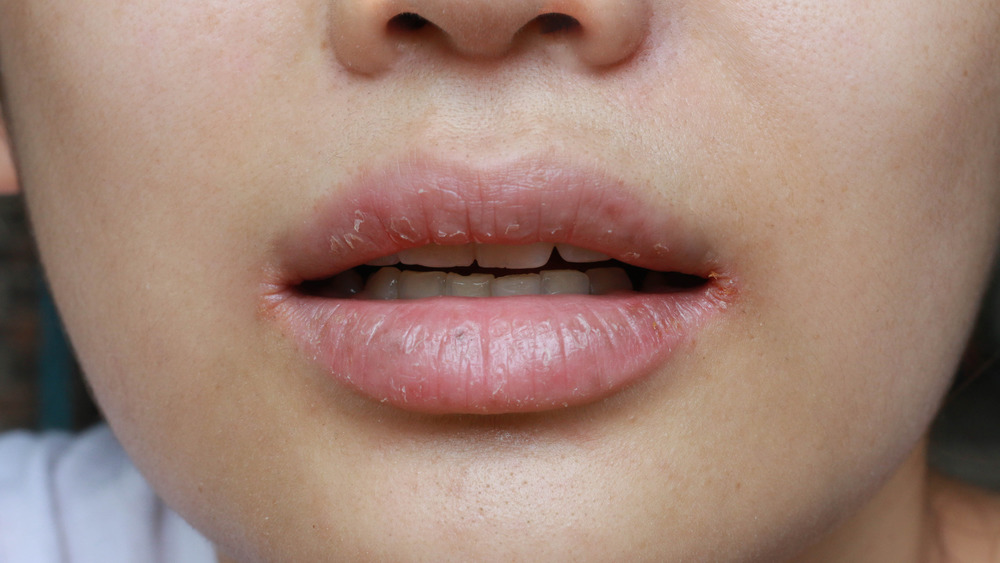 Woman with dry, cracked lips