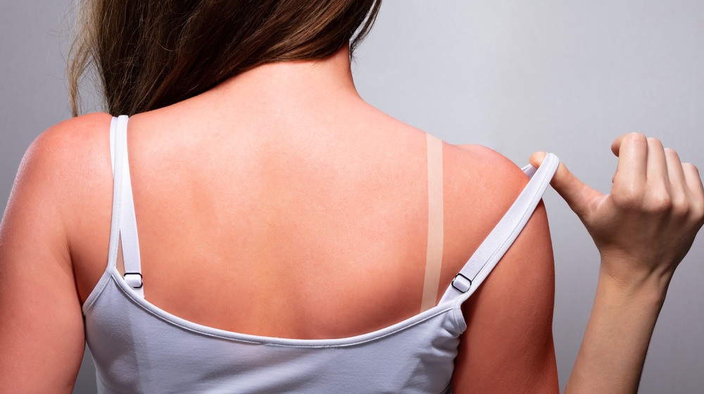 Woman with sunburn on back and shoulders