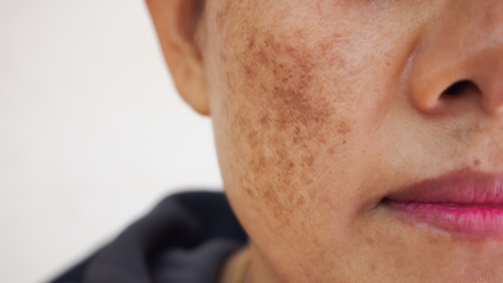 Woman with dark spots and premature aging