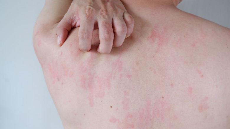 person with hives down back 