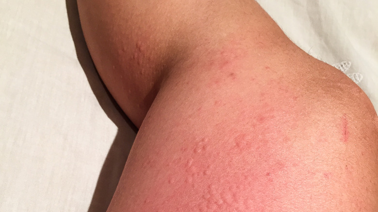Leg with cold urticaria skin rash