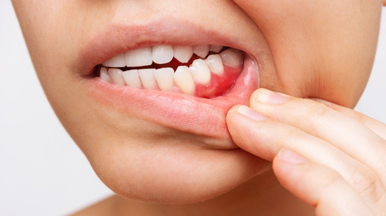 Woman holding lip showing gum inflammation