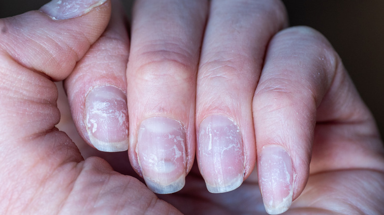 brittle and damaged nails 