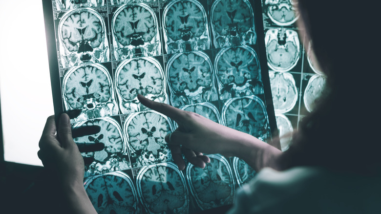 Alzheimer's Disease on MRI