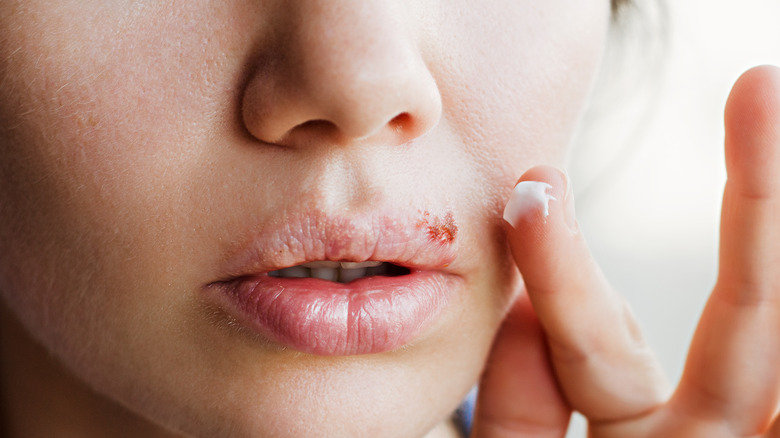 cold sore on woman's lip