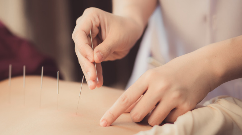 close-up of acupuncture