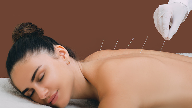 relaxed woman receiving acupuncture