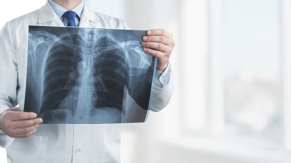 Doctor holding lung xray