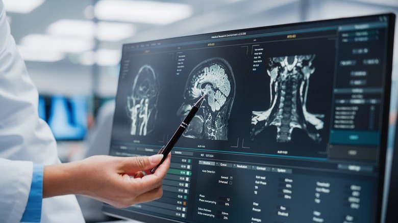 neurologist examining scan of brain