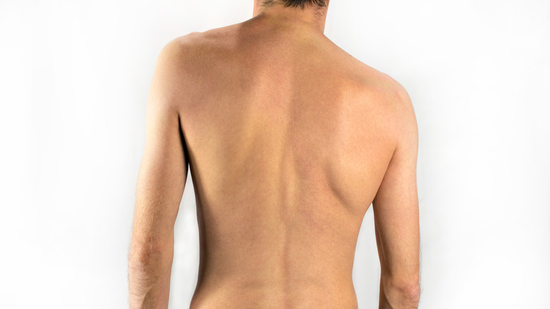 Adult male with scoliosis