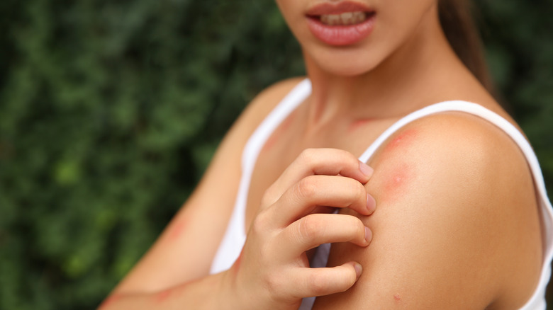 woman scratching bug bite