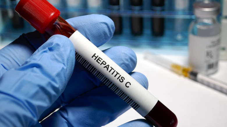 Blood sample for Hepatitis C testing