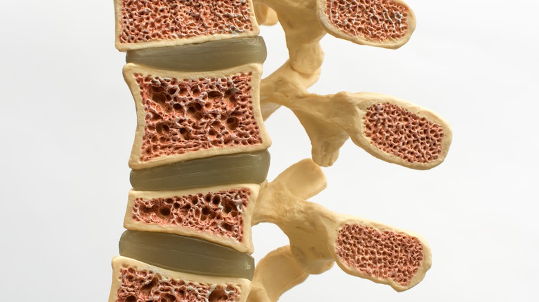 Human spine model showing brittle bones