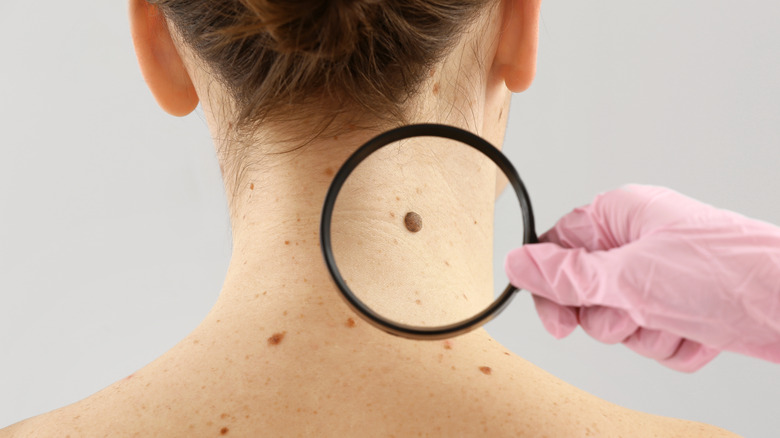 doctor examining moles on a woman