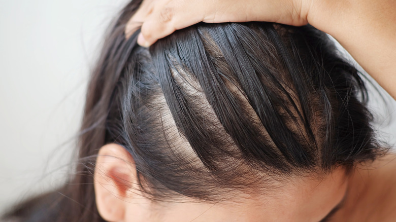 woman with thinning hair due to aging