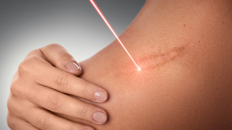 closeup of someone receiving laser treatment on their scar