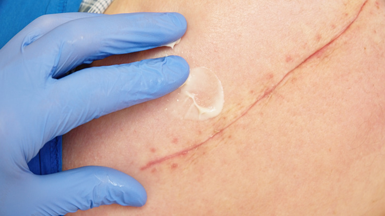 closeup of a nurse massaging a surgical scar