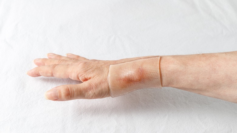 an arm extended with a silicone patch applied to scar
