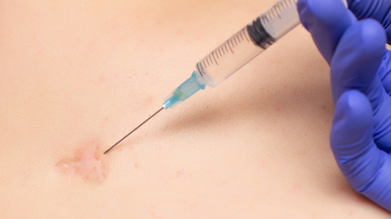a closeup of a person receiving an injection in a scar on their back