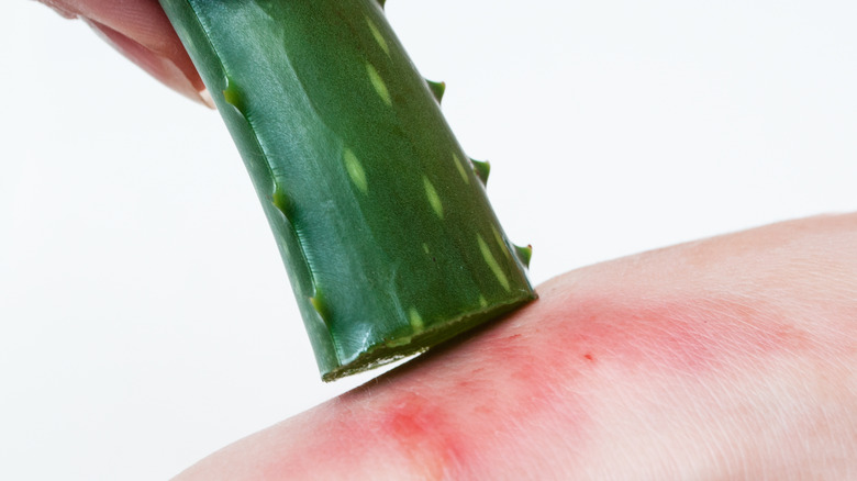 person applying aloe vera to red skin 