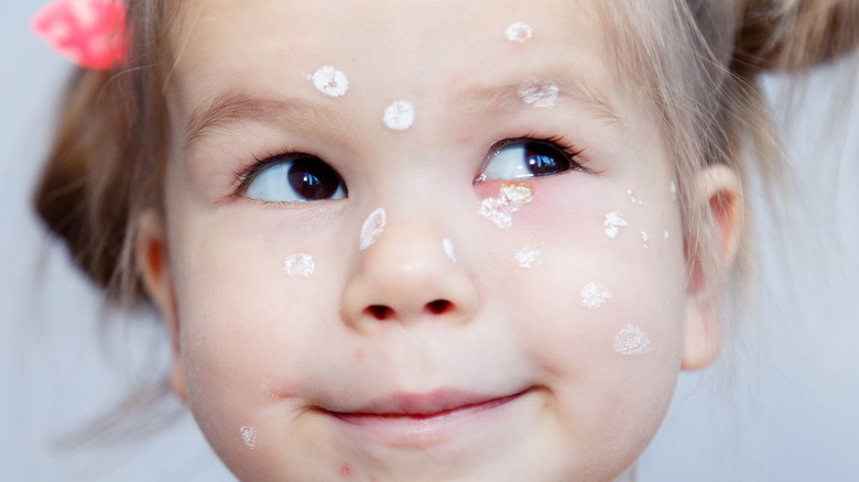 girl with calamine lotion on chicken pox
