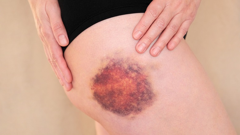 Large bruise on a thigh