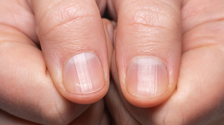 person with ridged nails