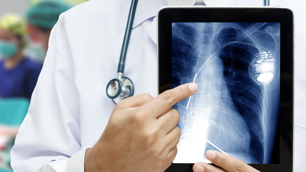 Doctor wearing stethoscope and holding tablet with picture of a chest x-ray showing pacemaker implanted