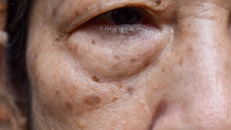 Woman with wrinkles and hyperpigmentation