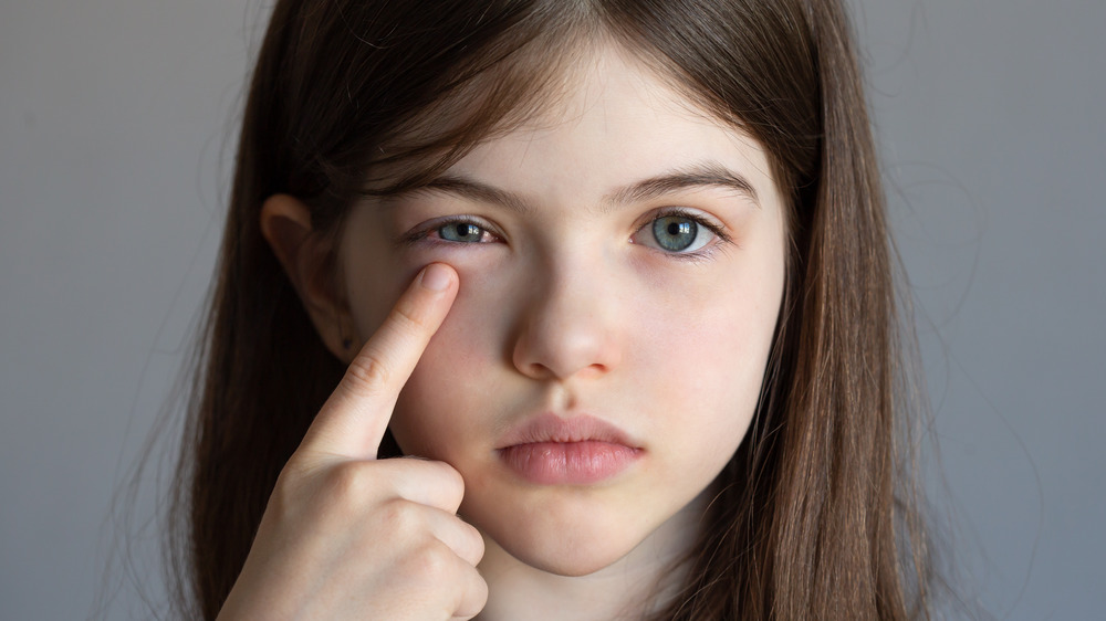Young girl with conjunctivitis pointing to her eye