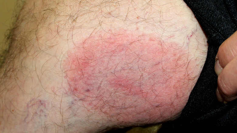 a bull's-eye shaped rash from a tick bite 