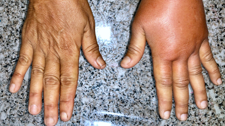 Swollen hands caused by lymphedema