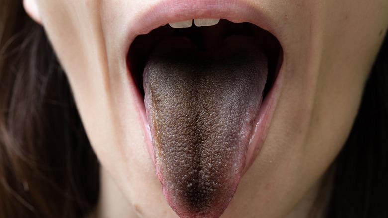 closeup of a woman with black hairy tongue 