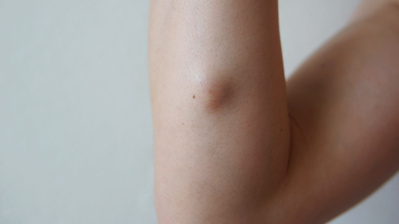 sebaceous cyst on arm