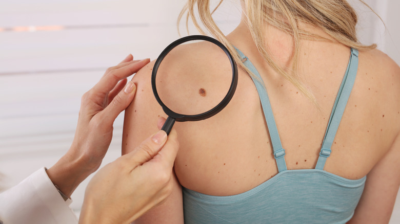 A doctor examining a skin mark