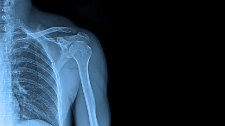 X-ray images shoulder joint to see injuries of tendons and bones for a medical diagnosis