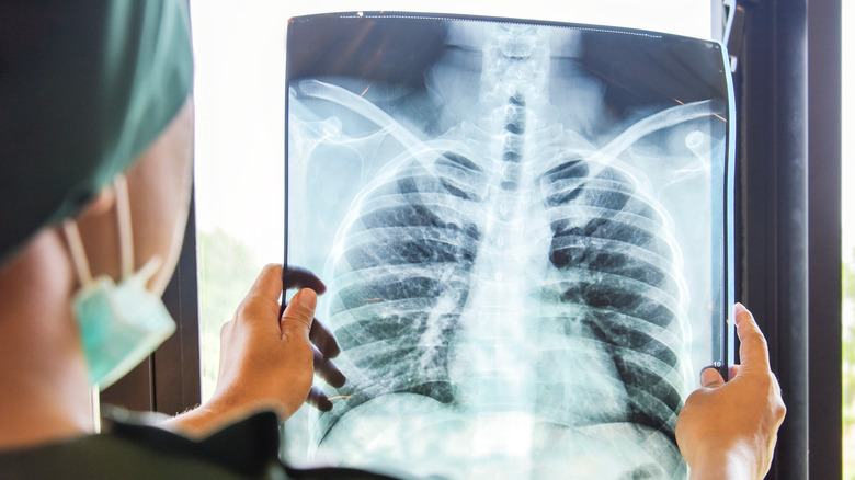 Doctor examining chest bone x-ray