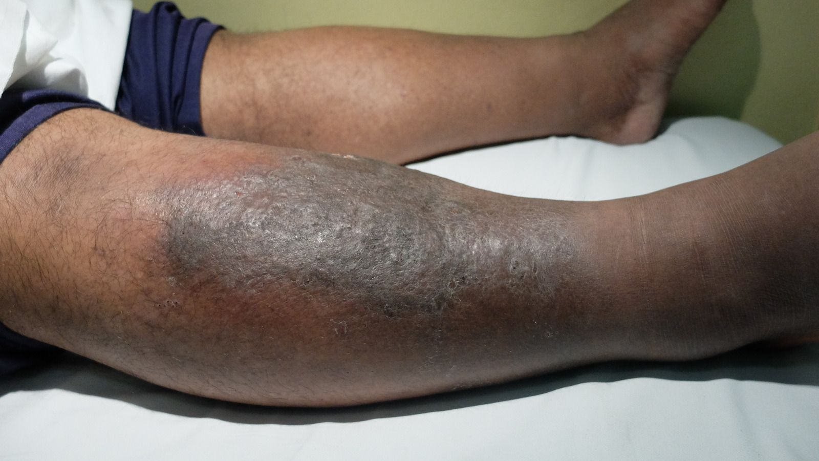 This Is What You Can Do To Prevent Cellulitis 