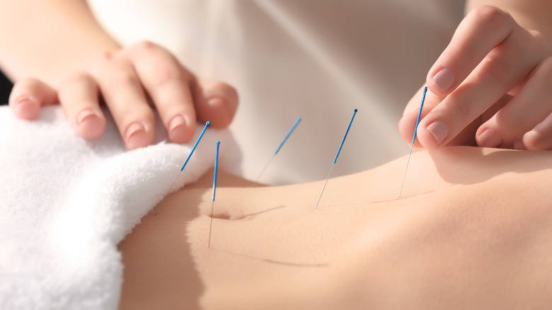 acupuncture on belly close up