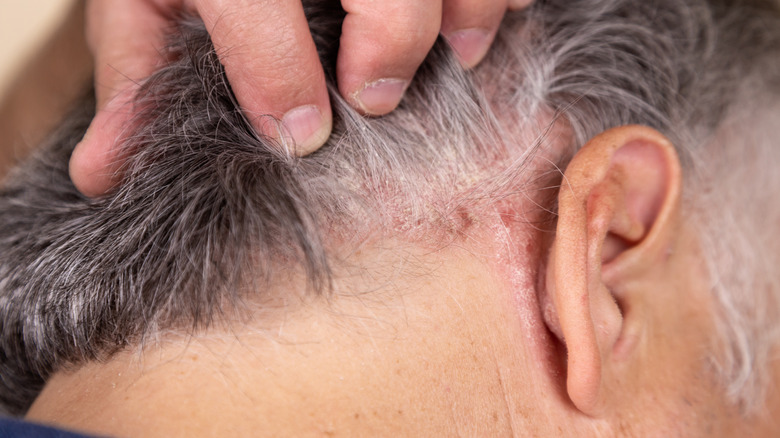 man holding hair showing psoriasis behind ear