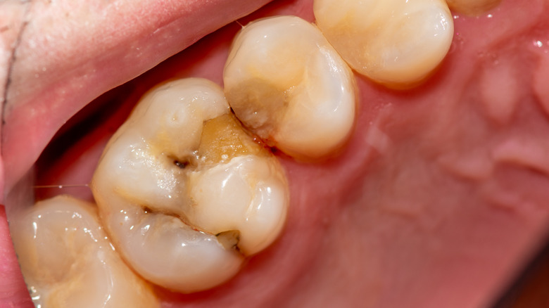 close-up of 4 teeth wuth cavities
