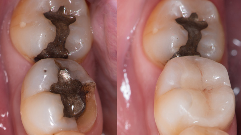 4 lower teeth showing dental fillings