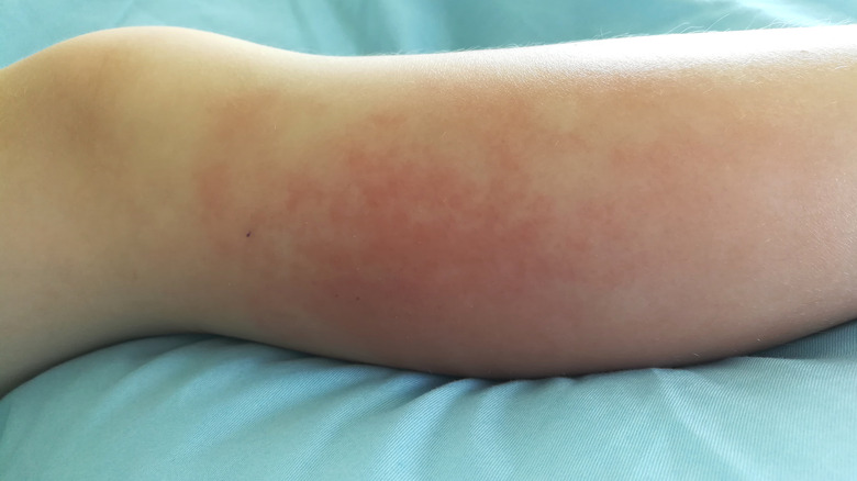 Leg with cellulitis