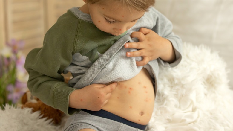 Child with chicken pox