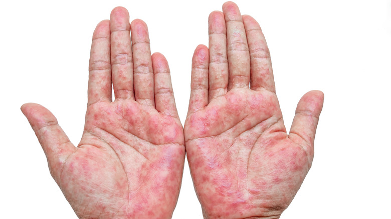 Severe contact dermatitis