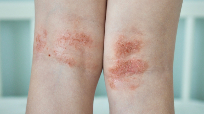 Types Of Skin Rashes Explained 