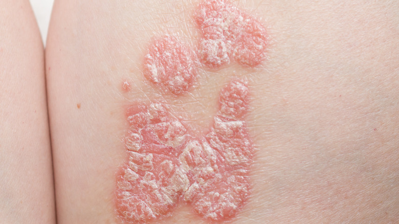 Psoriasis example