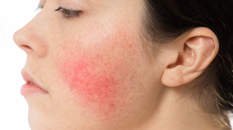 Woman with rosacea