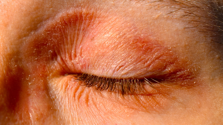 eczema around the eyes