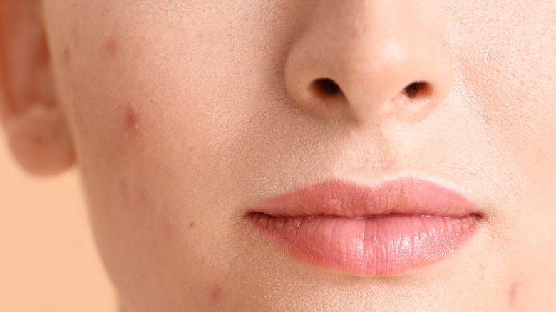 closeup of young woman with acne scars